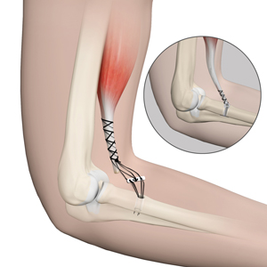 Distal Biceps Repair