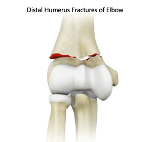 Distal Humerus Fractures of the Elbow 