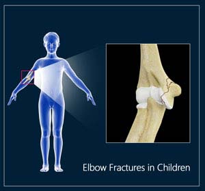 Elbow Fractures in Children 